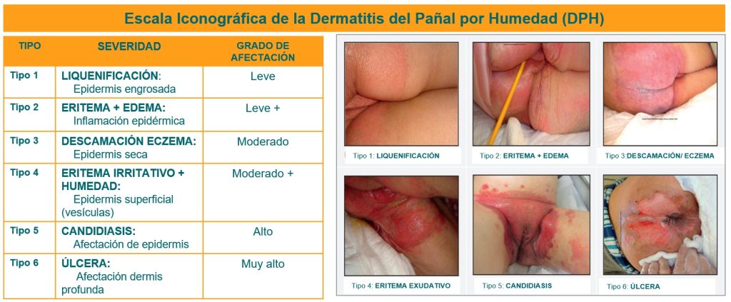  Escala iconográfica de la dermatitis del pañal por humedad (DPH)